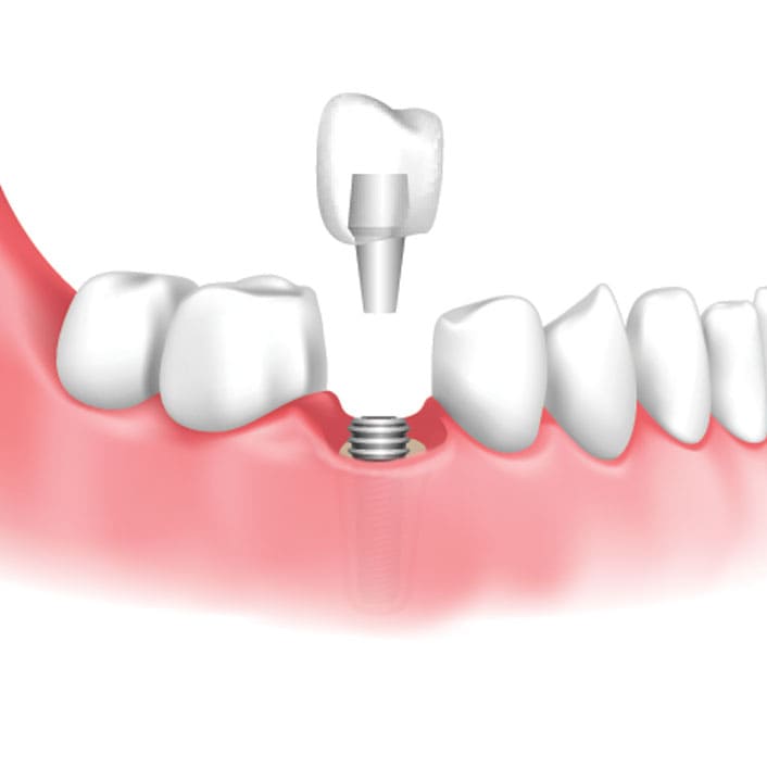 Implant Restoration